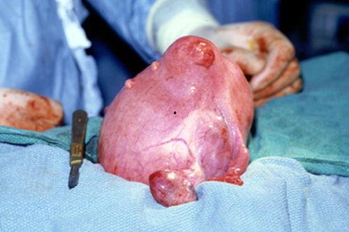 瘤子的图片,微观视角下的病理特征解读