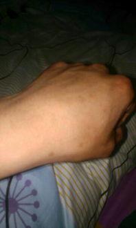 瘤子的图片,微观视角下的病理特征解读